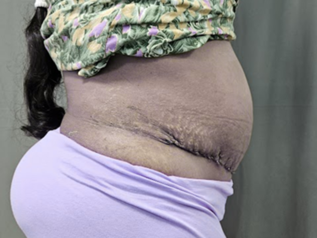 Tummy Tuck Results